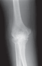Illustration of elbow degenerative joint disease - Dr. Mohammed Hutaif