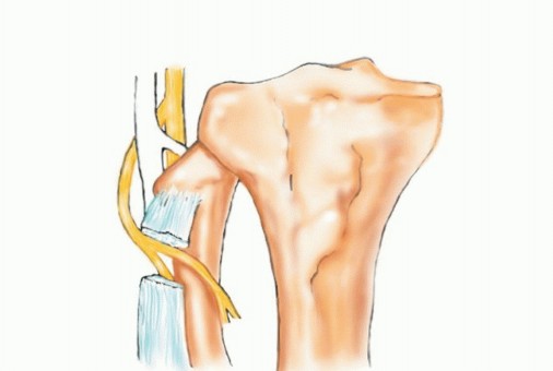 Beyond Amputation: The Type I Resection in Fibular Tumor Surgery