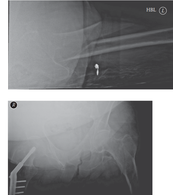 Decoding Subtrochanteric Hip Fracture: Causes, Types, and Care