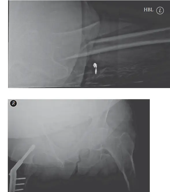 صورة توضيحية لـ كسور تحت المدور في الفخذ: دليل شامل من التشخيص إلى التعافي مع الأستاذ الدكتور محمد هطيف