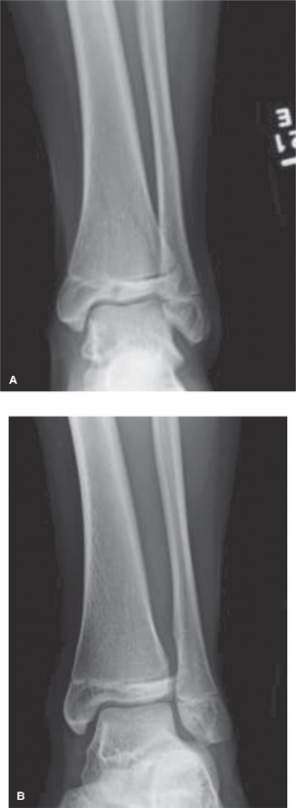Illustration 2 for Unraveling 10 Pediatric Cases: Surgical Reduction and Internal Fixation