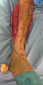 Illustration 11 for Complex Tibial Shaft Fracture: Plate Fixation for Plafond Extension