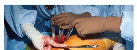 Illustration 11 for Surgical Hip Dislocation Safety: The Branch of the MFCA's Vital Role