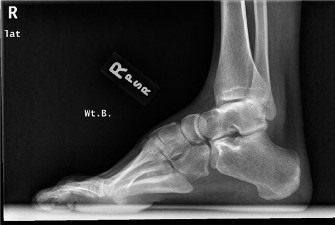Pes Cavus & Ankle Pain: When to Use Coleman Block Testing