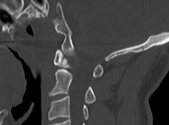 Illustration 13 for Adjacent Segment Degeneration: Your Next Spine Case Solved