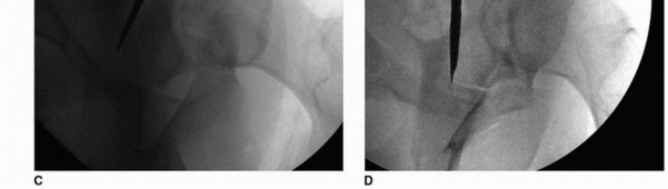 Illustration 22 for Periacetabular Osteotomy: Realigning your hip via the superior pubic ramus