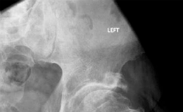 Illustration 3 for Patient Case: Resurfacing Primary Hip Arthroplasty for Lasting Relief