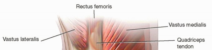 Correcting Stiffness in Revision TKA: Achieve Appropriate External Rotation