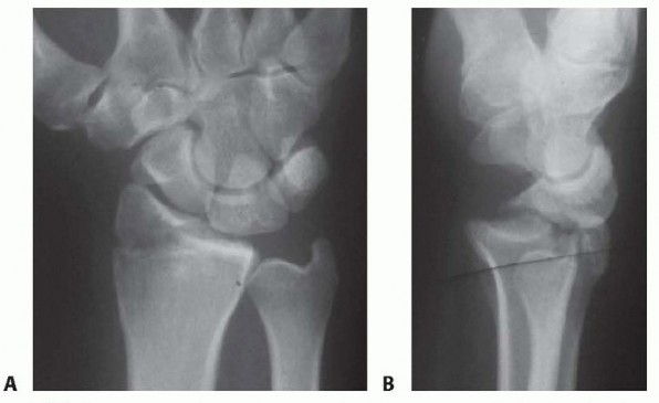Arthroscopic Fixation: Effectively Treating Radial Styloid Fragments