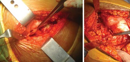 صورة طبية: استبدال مفصل الورك الكلي لالتهاب المفاصل الروماتويدي اليفعي: استعادة الحركة والأمل مع الأستاذ الدكتور محمد هطيف في صنعاء
