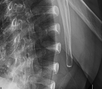 Illustration 34 for Right Shoulder Pain? Avoid This Common X-ray Mistake.