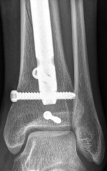 Illustration 31 for Tibial Fracture Extending into the Plafond: Intramedullary Secrets