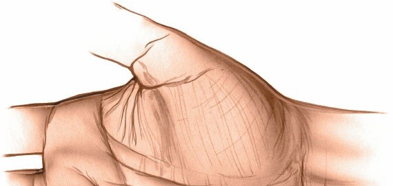 How to Safely Drain the Medial Midpalmar Space