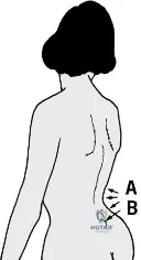 Prolapsed Intervertebral Disc: Understanding Your Spinal Anatomy