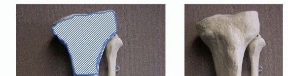 Intramedullary Nailing: Mastering Proximal or Distal Tibial Fractures