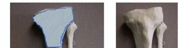 صورة توضيحية لـ كسور مفصل الركبة والكاحل (كسور النهايات العظمية للساق): الدليل الشامل للمرضى