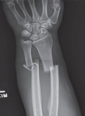 Illustration of radial bow radial - Dr. Mohammed Hutaif