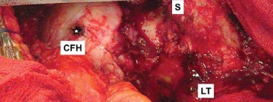 Illustration 11 for Mastering Soft Tissue Balancing for Optimal THR Outcomes