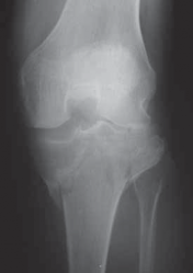 Illustration of fixation of the bicondylar - Dr. Mohammed Hutaif