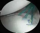 Posterior Shoulder Instability: Arthroscopic Shoulder J Bone Joint Solutions