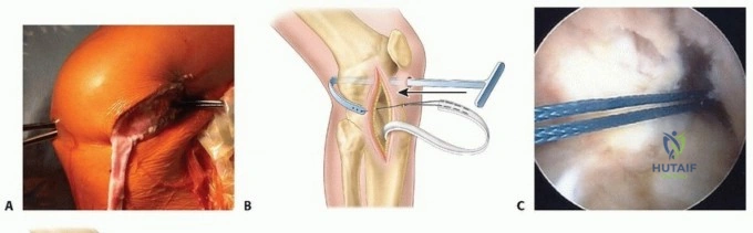 Operative Strategies in Tendon-to-Bone Attachment and Flexor Tendon Repair