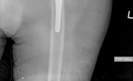 Illustration 7 for How We Tackled Massive Bone Loss in a Revision Hip Arthroplasty
