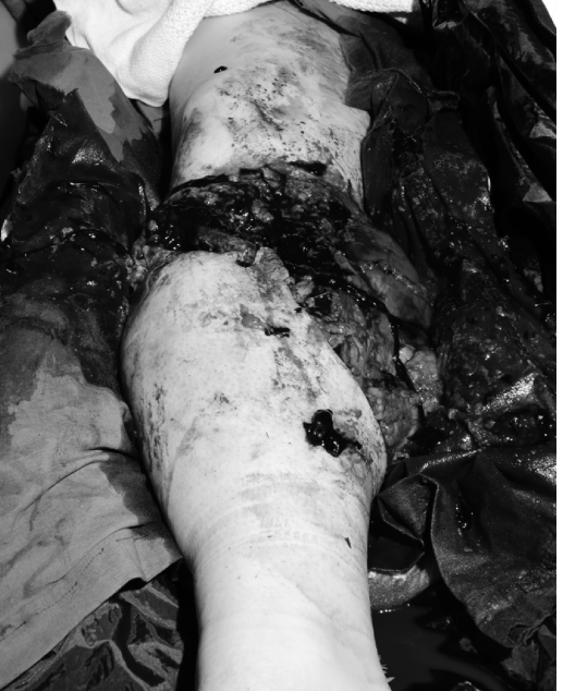 Mangled Lower Extremity Trauma: A Case Study of Gustilo IIIC Open Tibia Fracture with Vascular Compromise