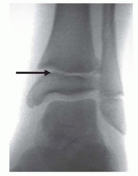 Navigating Pediatric Ankle Fractures: Avoiding Premature Physeal Closure