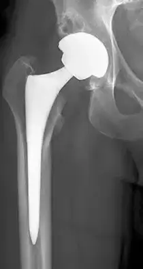 الدليل الشامل لاستبدال مفاصل الورك والركبة: رعاية متخصصة في اليمن مع الأستاذ الدكتور محمد هطيف