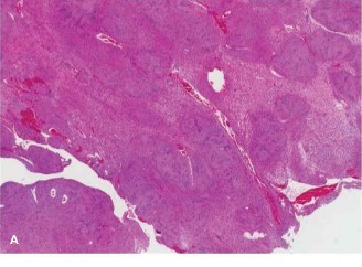 Orthopaedic Oncology Cases: Is Your Schwannoma Benign or Malignant?