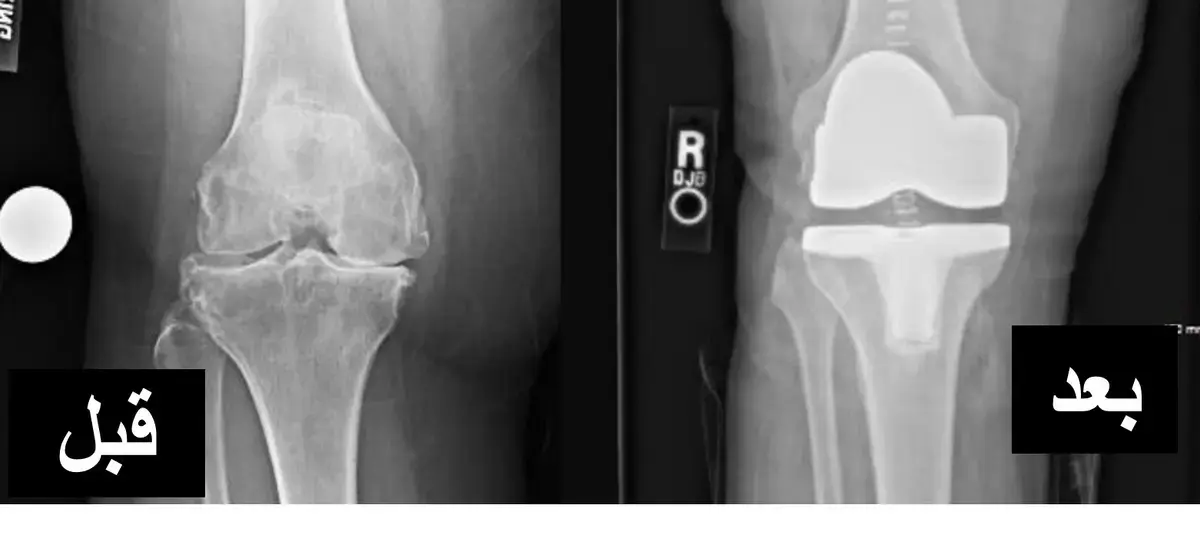 اكتشف أسرار خلع الركبة: فهم شامل للتشخيص والتعافي الفعال