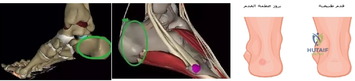 صورة توضيحية 6 لموضوع وداعاً لـ الم القدم والكاحل: الأسباب الخفية، الأعراض، العلاج والوقاية