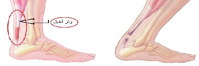 التهاب الوتر العقبي  Achilles tendinitis