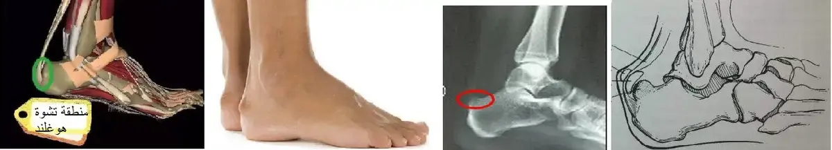 تحقيق التعافي الكامل: علاج كسور العضد القريبه بفعالية