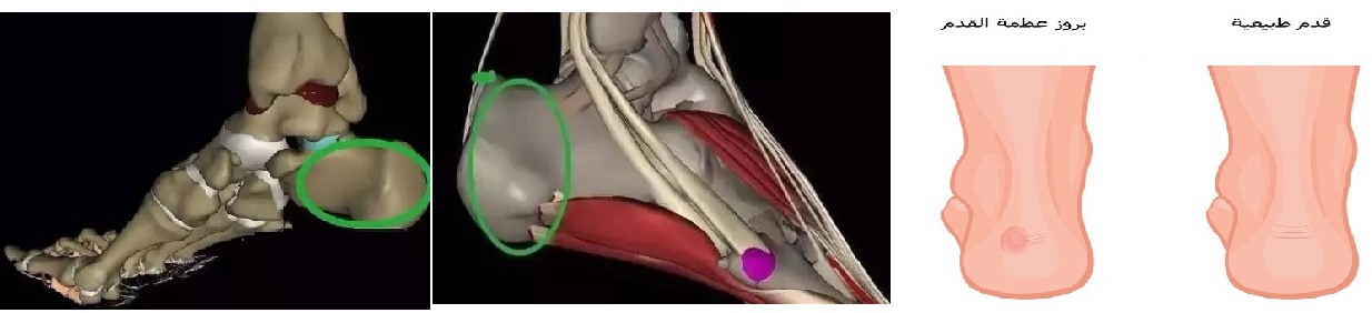 بروز عظمة العقب