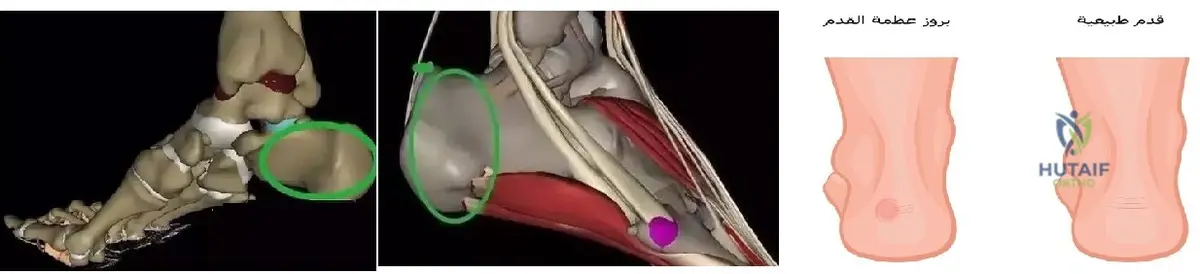 بروز عظمه العقب: وداعًا للألم! دليل شامل للأسباب والعلاج.