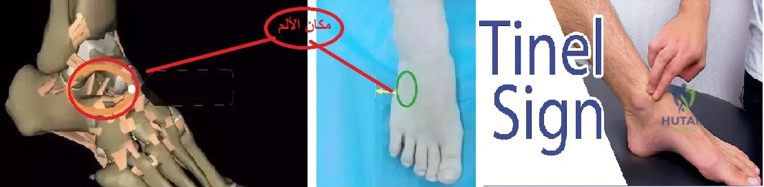 صورة توضيحية 14 لموضوع وداعاً لـ الم القدم والكاحل: الأسباب الخفية، الأعراض، العلاج والوقاية