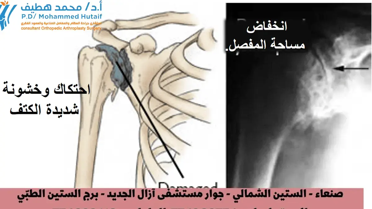 دليلك الشامل لآلام المرفق: أسباب وعلاج فعال