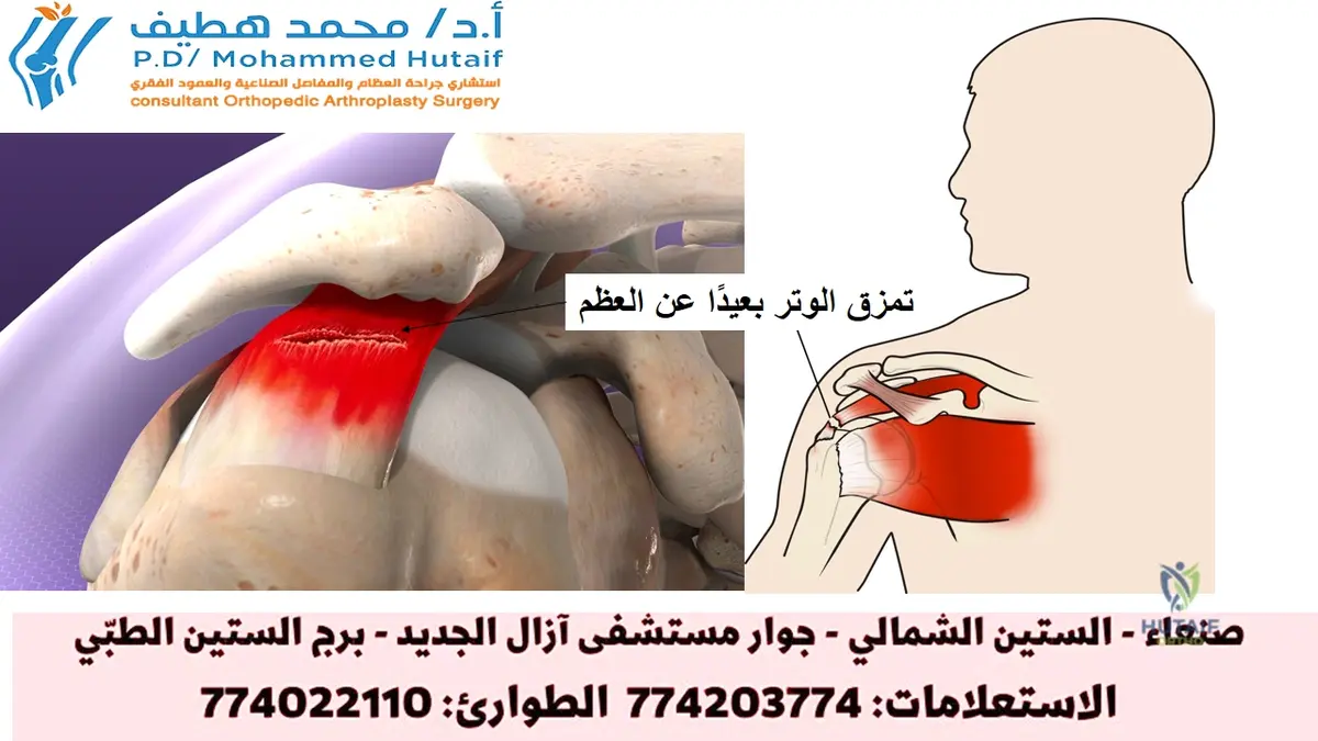 تخلص من ألم الكتف: فهم وعلاج تمزق اوتار الكفه المدوره بفعالية