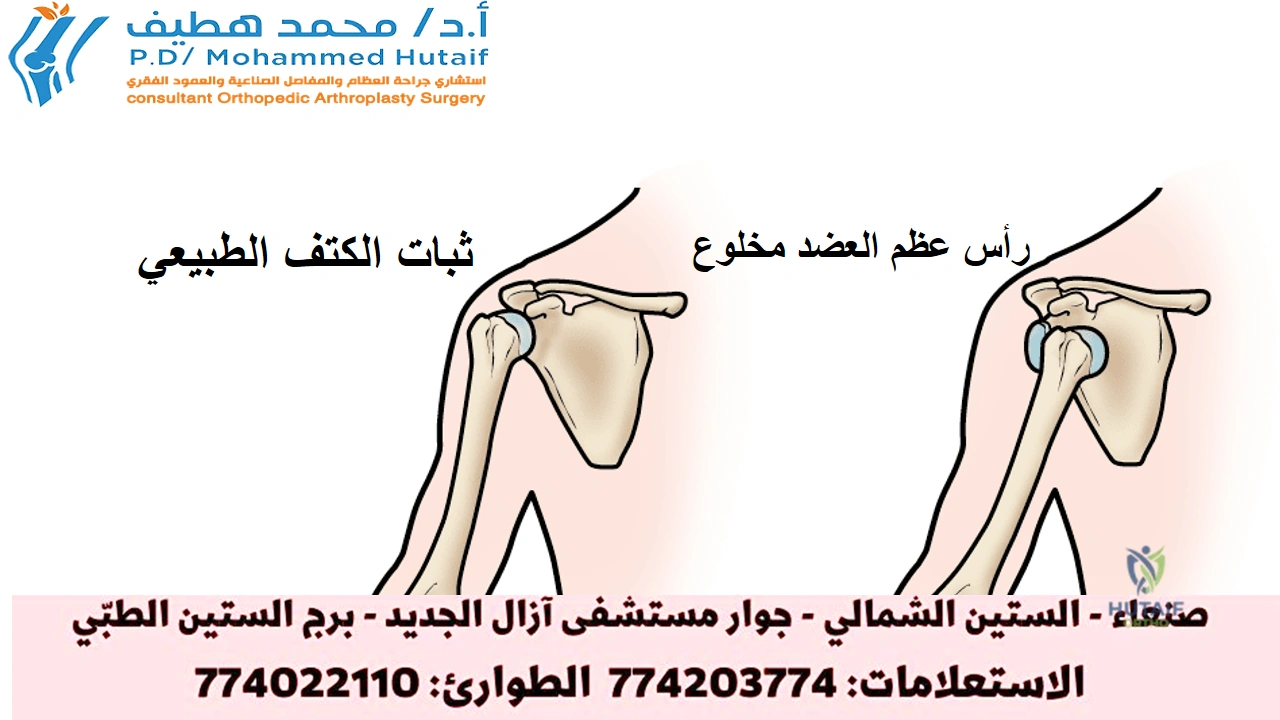 صورة توضيحية 2 لموضوع وداعاً لخلع الكتف المتكرر: فهم وعلاج عدم استقرار الكتف