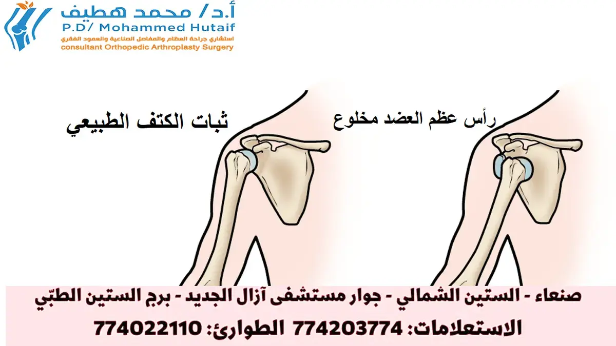 اكسر خوفك: دليلك الكامل لكسور عنق الفخذ، تشخيصها وعلاجها