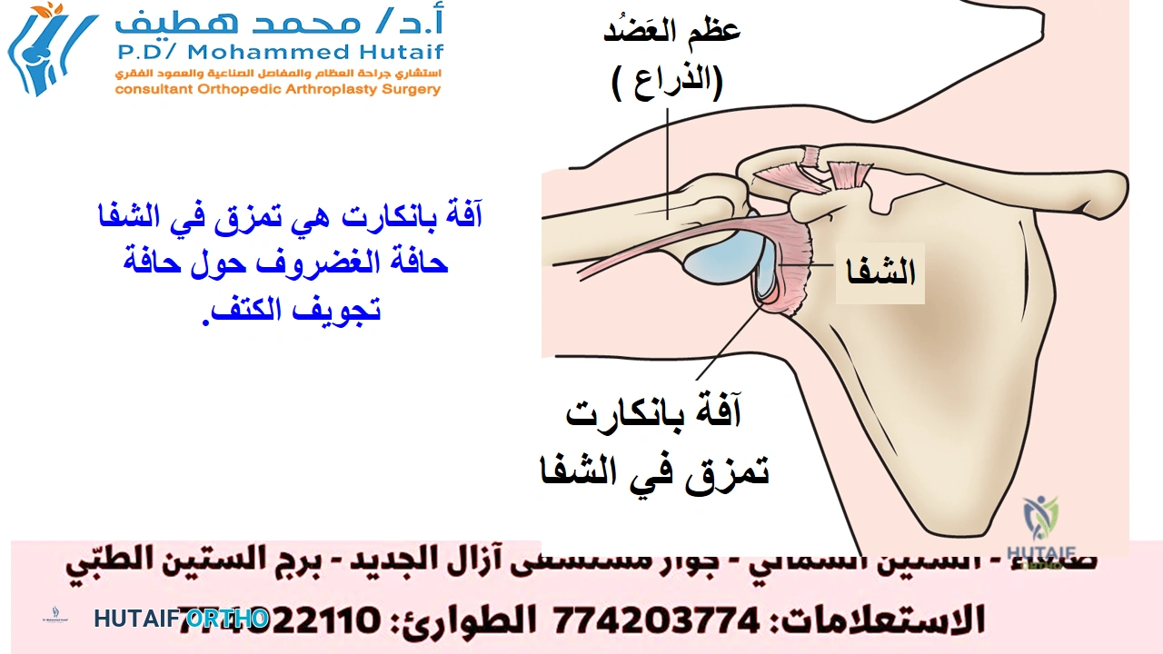 صورة توضيحية 3 لموضوع وداعاً لخلع الكتف المتكرر: فهم وعلاج عدم استقرار الكتف