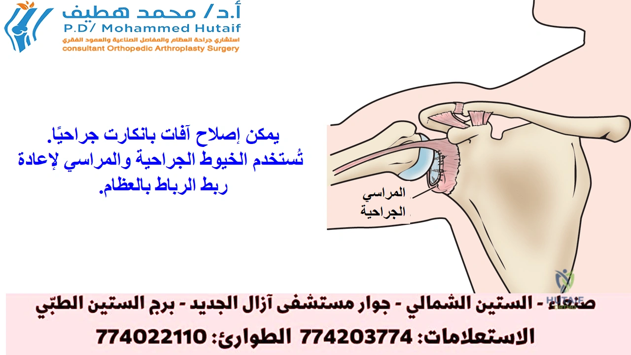 صورة توضيحية 4 لموضوع وداعاً لخلع الكتف المتكرر: فهم وعلاج عدم استقرار الكتف