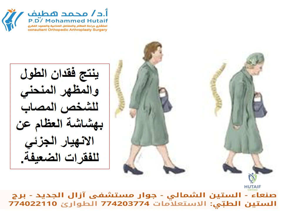 صورة توضيحية 2 لموضوع نصائح دكتور العظام: كيف تتجنب انخفاض كتلة العظام وهشاشة العظام؟