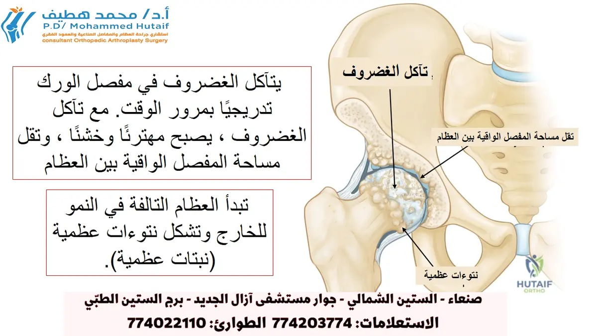عملية مفصل الورك بالكامل: تخلص من الألم واستعد حركتك الكاملة