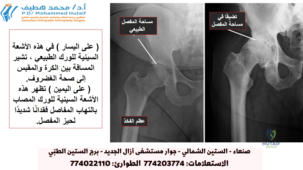 هل جراحة استبدال مفصل الورك مناسبة لك؟ يجب أن يكون قرار إجراء جراحة استبدال مفصل الورك قرارًا تعاونيًا تتخذه أنت وعائلتك وطبيب الرعاية الأولية وجراح العظام. تبدأ عملية اتخاذ هذا القرار عادةً بإحالة ا.د محمد هطيف إلى جراح العظام لإجراء تقييم أولي. عندما ينصح بالجراحة هناك عدة أسباب قد تجعل ا.د محمد هطيف يوصي بإجراء جراحة استبدال مفصل الورك. غالبًا ما يعاني الأشخاص الذين يستفيدون من جراحة استبدال مفصل الورك من: • ألم الورك الذي يحد من الأنشطة اليومية ، مثل المشي أو الانحناء • ألم الورك الذي يستمر أثناء الراحة ، ليلاً أو نهارًا • تصلب في الورك يحد من القدرة على تحريك أو رفع الساق • تخفيف الآلام غير الكافي من الأدوية المضادة للالتهابات أو العلاج الطبيعي أو دعامات المشي المرشحون للجراحة لا توجد قيود مطلقة للعمر أو الوزن لاستبدال مفصل الورك. تستند توصيات الجراحة إلى ألم المريض وإعاقته، وليس العمر. معظم المرضى الذين خضعوا لاستبدال مفصل الورك تتراوح أعمارهم بين 50 و 80 عامًا، لكن جراحي العظام يقومون بتقييم المرضى بشكل فردي. تم إجراء عمليات استبدال مفصل الورك بالكامل بنجاح في جميع الأعمار ، من المراهق الشاب المصاب بالتهاب المفاصل عند الأطفال إلى المريض المسن المصاب بالتهاب المفاصل التنكسي. تقييم العظام يتكون التقييم مع جراح العظام من عدة مكونات: تاريخ طبى. سيجمع جراح العظام معلومات عن صحتك العامة ويطرح أسئلة حول مدى ألم الورك وكيف يؤثر على قدرتك على أداء الأنشطة اليومية. الفحص البدني. سيقيم هذا حركة الورك والقوة والمحاذاة. الأشعة السينية. تساعد هذه الصور في تحديد مدى الضرر أو التشوه في الورك. اختبارات أخرى. من حين لآخر ، قد تكون هناك حاجة لاختبارات أخرى ، مثل التصوير بالرنين المغناطيسي /(MRI/) لتحديد حالة العظام والأنسجة الرخوة في الورك. الأشعة السينية للورك الطبيعي والورك مع التهاب المفاصل /(على اليسار/) في هذه الأشعة السينية للورك الطبيعي ، تشير المسافة بين الكرة والمقبس إلى صحة الغضروف. /(على اليمين/) تظهر هذه الأشعة السينية للورك المصاب بالتهاب المفاصل فقدانًا شديدًا لحيز المفصل.