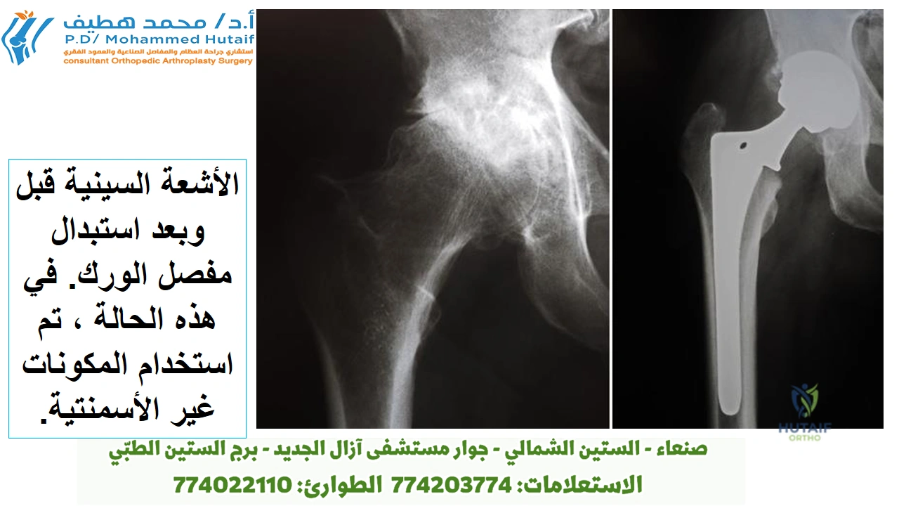 إجراء تستغرق العملية الجراحية عادة من ساعة إلى ساعتين. سيقوم جراح العظام الخاص بك بإزالة الغضروف والعظام التالفين ثم وضع غرسات معدنية أو بلاستيكية أو خزفية جديدة لاستعادة محاذاة ووظيفة الورك. الأشعة السينية قبل وبعد استبدال مفصل الورك. الأشعة السينية قبل وبعد استبدال مفصل الورك. في هذه الحالة ، تم استخدام المكونات غير الأسمنتية. بعد الجراحة ، سيتم نقلك إلى غرفة الإنعاش حيث ستبقى لعدة ساعات بينما تتم متابعة تعافيك من التخدير. بعد أن تستيقظ ، سيتم اصطحابك إلى غرفتك بالمستشفى أو خروجك إلى المنزل. استعادة يعتمد نجاح الجراحة إلى حد كبير على مدى اتباعك لتعليمات جراح العظام فيما يتعلق بالرعاية المنزلية خلال الأسابيع القليلة الأولى بعد الجراحة. إدارة الألم غالبًا ما توصف الأدوية لتخفيف الآلام على المدى القصير بعد الجراحة. تتوفر العديد من أنواع الأدوية للمساعدة في إدارة الألم ، بما في ذلك المواد الأفيونية والأدوية غير الستيرويدية المضادة للالتهابات /(NSAIDs/) والأسيتامينوفين والمخدرات الموضعية. قد يستخدم ا.د محمد هطيف مجموعة من هذه الأدوية لتحسين تخفيف الألم ، وكذلك تقليل الحاجة إلى المواد الأفيونية. اعلم أنه على الرغم من أن المواد الأفيونية تساعد في تخفيف الألم بعد الجراحة ، إلا أنها مخدرة ويمكن أن تسبب الإدمان. أصبح الاعتماد على المواد الأفيونية والجرعة الزائدة من المشكلات الصحية العامة الحرجة في الولايات المتحدة. من المهم استخدام المواد الأفيونية فقط وفقًا لتوجيهات الطبيب. بمجرد أن يبدأ الألم في التحسن ، توقف عن تناول المواد الأفيونية. تحدث إلى ا.د محمد هطيف إذا لم يبدأ الألم في التحسن في غضون أيام قليلة من الجراحة. العناية بالجروح قد يكون لديك غرز أو دبابيس تعمل على طول الجرح أو خياطة تحت الجلد. ستتم إزالة الغرز أو الدبابيس بعد أسبوعين تقريبًا من الجراحة. تجنب تبلل الجرح حتى يغلق تمامًا ويجف. يمكنك الاستمرار في تضميد الجرح لمنع تهيج الملابس أو الجوارب الداعمة. حمية فقدان الشهية أمر شائع لعدة أسابيع بعد الجراحة. النظام الغذائي المتوازن ، غالبًا مع مكمل الحديد ، مهم لتعزيز التئام الأنسجة السليم واستعادة قوة العضلات. تأكد من شرب الكثير من السوائل. نشاط التمرين عنصر حاسم في الرعاية المنزلية ، خاصة خلال الأسابيع القليلة الأولى بعد الجراحة. يجب أن تكون قادرًا على استئناف معظم الأنشطة الخفيفة العادية للحياة اليومية في غضون 3 إلى 6 أسابيع بعد الجراحة. بعض الانزعاج من النشاط والليل شائع لعدة أسابيع. يجب أن يتضمن برنامج نشاطك ما يلي: برنامج مشي متدرج لزيادة قدرتك على الحركة ببطء ، في البداية في منزلك ثم في الخارج لاحقًا استئناف الأنشطة المنزلية العادية الأخرى ، مثل الجلوس والوقوف وصعود السلالم تمارين محددة عدة مرات في اليوم لاستعادة الحركة وتقوية الورك. من المحتمل أن تكون قادرًا على أداء التمارين دون مساعدة ، ولكن قد يكون لديك معالج فيزيائي يساعدك في المنزل أو في مركز العلاج في الأسابيع القليلة الأولى بعد الجراحة العلاج الطبيعي لاستبدال مفصل الورك سيساعد العلاج الطبيعي في استعادة القوة والقدرة على الحركة في الورك ،
