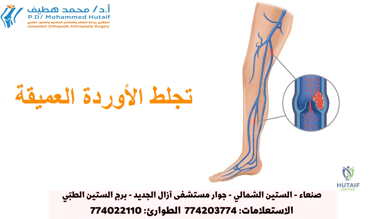 لطات الدم تعد الجلطات الدموية في أوردة الساق أو الحوض من أكثر مضاعفات جراحة استبدال مفصل الورك شيوعًا. يمكن أن تكون هذه الجلطات مهددة للحياة إذا تحررت وانتقلت إلى رئتيك. سيحدد جراح العظام برنامجًا وقائيًا قد يشمل أدوية ترقق الدم ، وخرطوم الدعم ، وأغطية الساق القابلة للنفخ ، وتمارين مضخة الكاحل ، والتعبئة المبكرة. تجلط الأوردة العميقة قد تتكون جلطات الدم في أحد الأوردة العميقة في الجسم. بينما يمكن أن تحدث جلطات الدم في أي وريد عميق ، إلا أنها تتشكل بشكل شائع في أوردة الحوض أو ربلة الساق أو الفخذ.