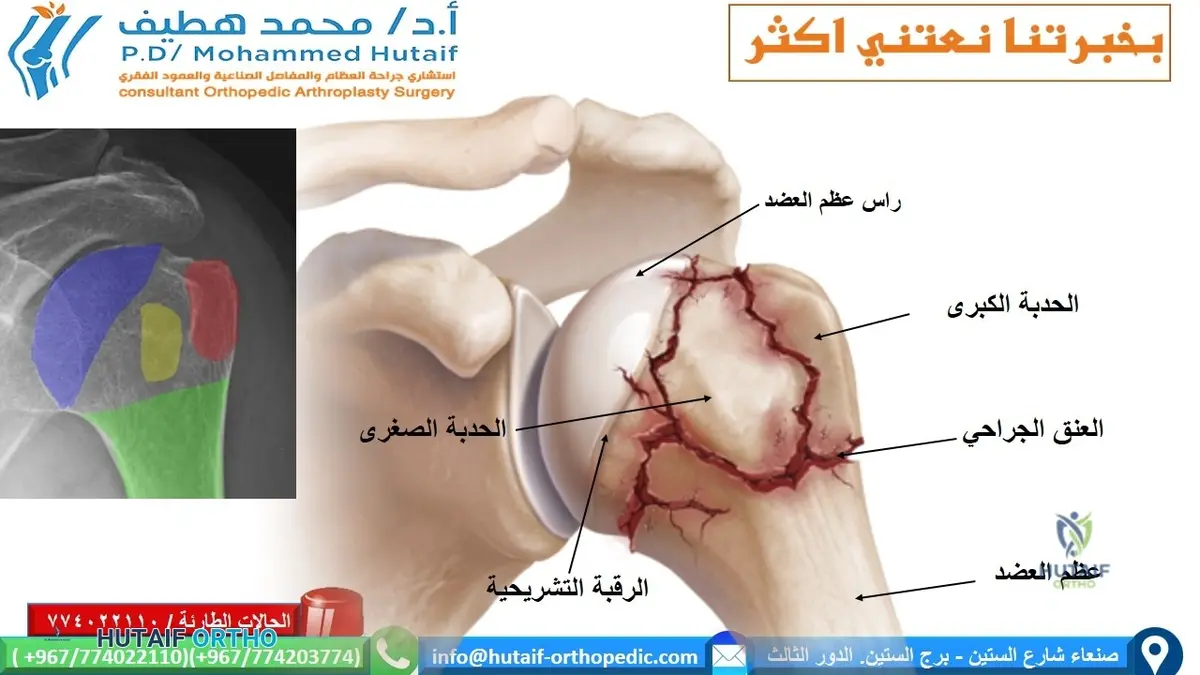 كسور العضد: دليلك الشامل لكل ما تحتاج معرفته