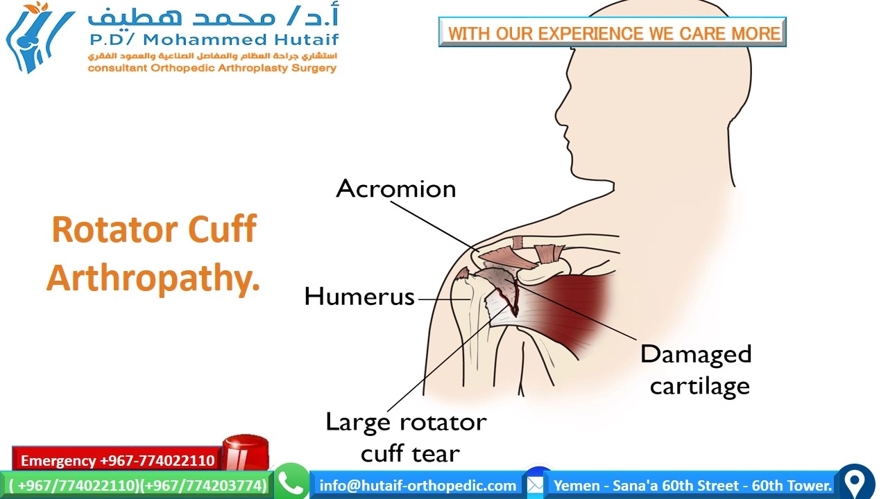 Understand Descriptionshoulder Osteoarthritis: Full Details Here